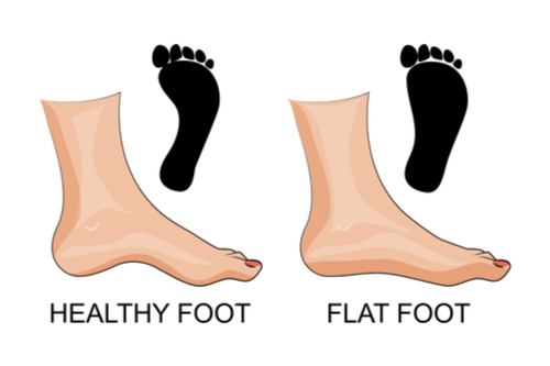 What Causes Flat Feet?